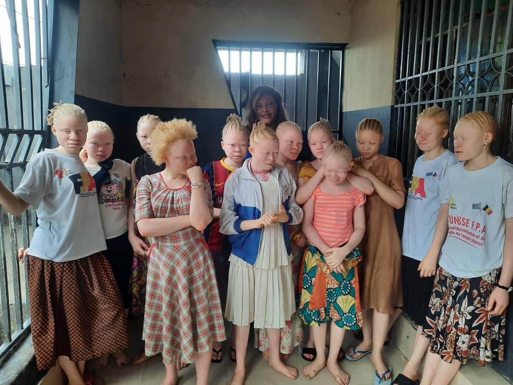 Zambia Albinism Alliance Board Member Calls for End to Stigma Against People with Albinism